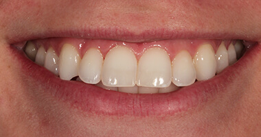 office teeth whitening after